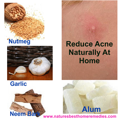reducing acne naturally with home remedies