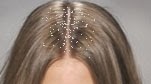 Natural remedies for seborrhea best home remedies for dandruff