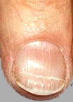 horizontal ridges in fingernails 