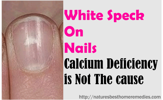 white speck on nails calcium deficiency