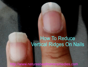 reduce vertical nail ridges