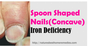 concave nails spoon shaped